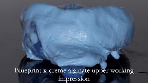 Finlay's Newsletter 64 case study - provision of a Kennedy class 2 metal based Scandinavian RPD for Ian