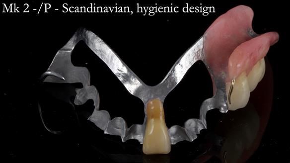 Newsletter 54 case presentation upper complete denture and lower Scandinavian designed hygienic partial denture for David