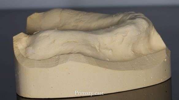 Newsletter 54 case presentation upper complete denture and lower Scandinavian designed hygienic partial denture for David