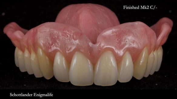 Newsletter 77: Jeremy’s case – immediate complete upper denture