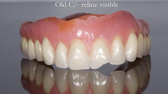 Replacing Madeline’s Complete denture FULL PROTOCOL