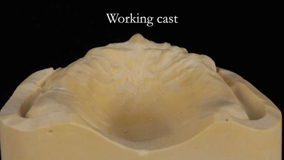 Finlay's Newsletter 62 provision of extractions and metal based complete dentures for Rafique