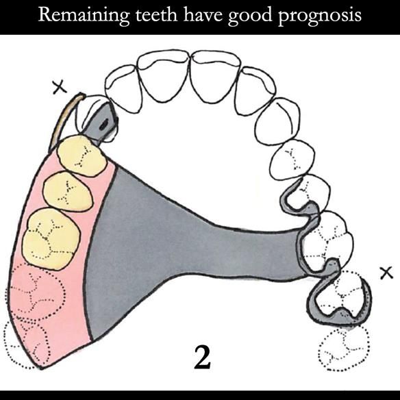 Universal Scandinavian partial denture designs