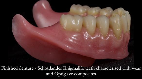 Newsletter 80 - Gordon’s dentures: the one case in 1,000 where my technique failed