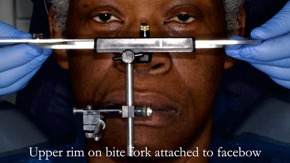 Newsletter 53 showing the making and fitting of ultra life-like dentures for Valena