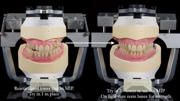 Newsletter 80 - Gordon’s dentures: the one case in 1,000 where my technique failed