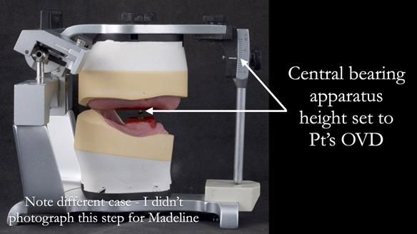 Replacing Madeline’s Complete denture FULL PROTOCOL