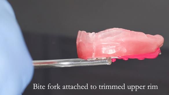 Finlay's Newsletter 62 provision of extractions and metal based complete dentures for Rafique