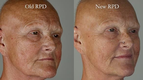 Newsletter 81 - Pam’s Story — how a partial denture changed her life (+ live walkthrough this Thursday)