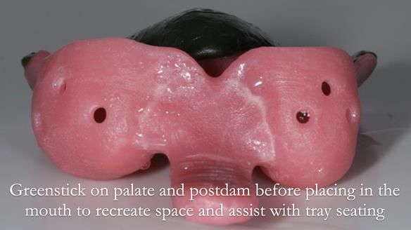 Finlay's Newsletter 59 Ultra hard partial dentures made for Gill