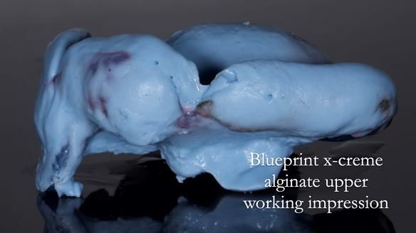 Newsletter 77: Jeremy’s case – immediate complete upper denture