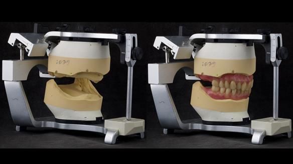 Complete denture Class II div 2 deep overbite Newsletter 39