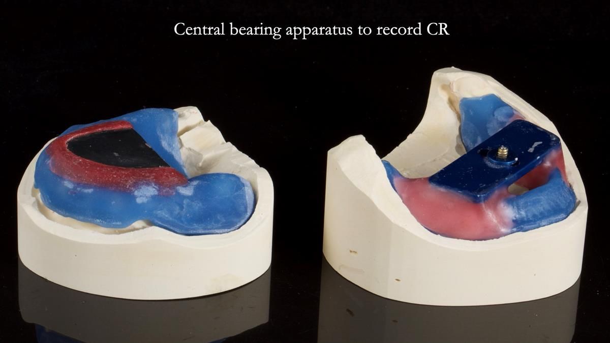 Fin’s Newsletter 88 — Complete dentures - full protocol… he rearranged his own teeth!