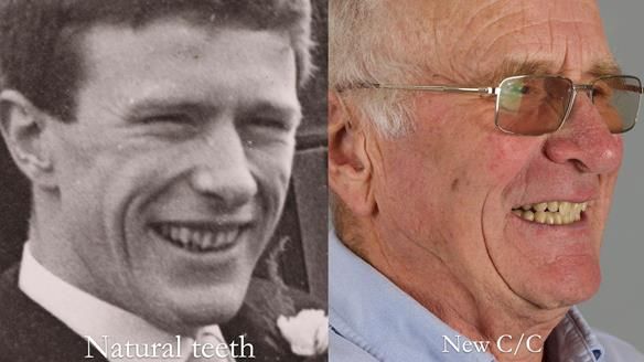 Complete denture Class II div 2 deep overbite Newsletter 39