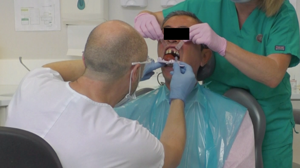 Figure 11 Modified stock tray with labial wall removed. Red cake compound placed in the palate to aid positioning of the tray