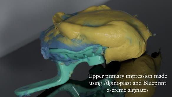 Newsletter 83: Sheila’s Complete Denture Success