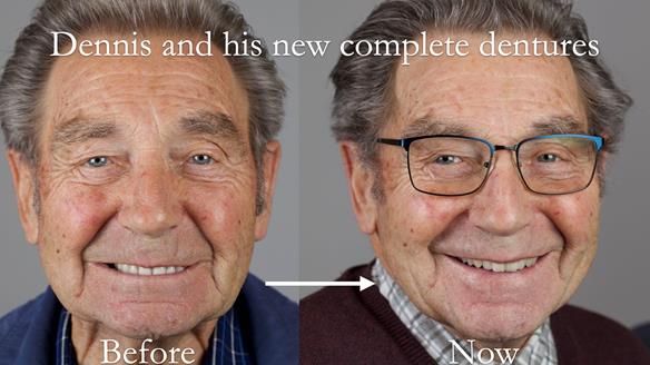 Newsletter 50 Special edition Complete Dentures FULL PROTOCOL