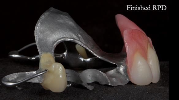 Newsletter 81 - Pam’s Story — how a partial denture changed her life (+ live walkthrough this Thursday)