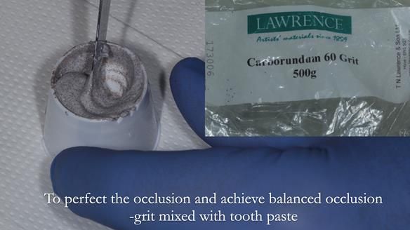 Newsletter 80 - Gordon’s dentures: the one case in 1,000 where my technique failed