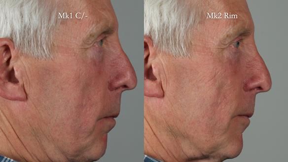 Newsletter 77: Jeremy’s case – immediate complete upper denture