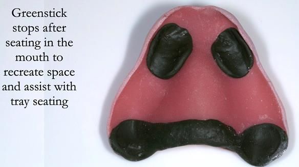 Newsletter 54 case presentation upper complete denture and lower Scandinavian designed hygienic partial denture for David