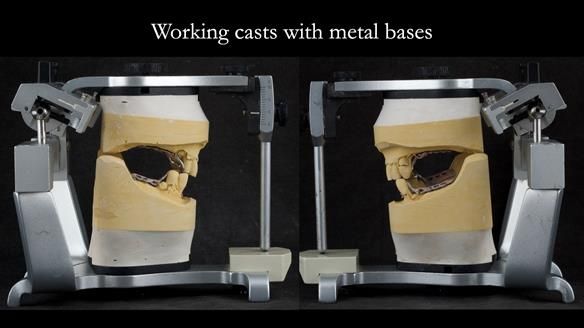 Finlay's Case Study Newsletter 40 - Immediate Mk 1 RPD to Definitive Mk 2 RPD - full protocol