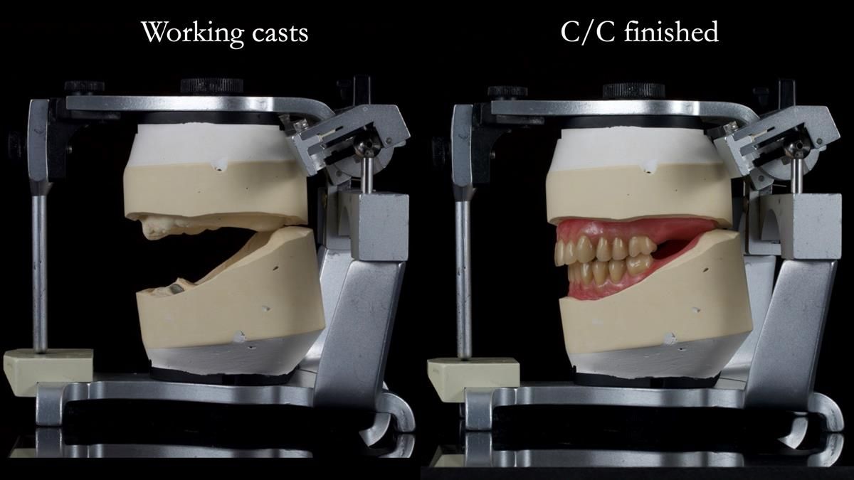 Fin’s Newsletter 88 — Complete dentures - full protocol… he rearranged his own teeth!
