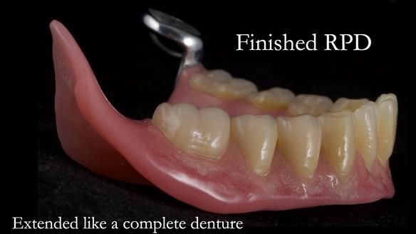 Finlay's Newsletter 59 Ultra hard partial dentures made for Gill