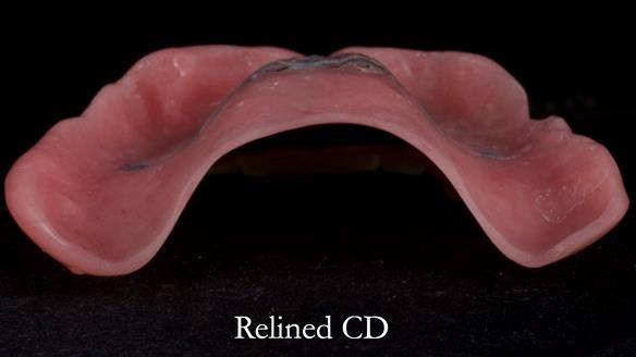 Finlay's Newsletter 62 provision of extractions and metal based complete dentures for Rafique