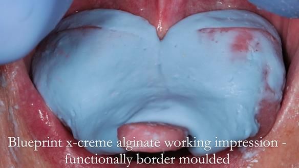 Finlay's Newsletter 59 Ultra hard partial dentures made for Gill