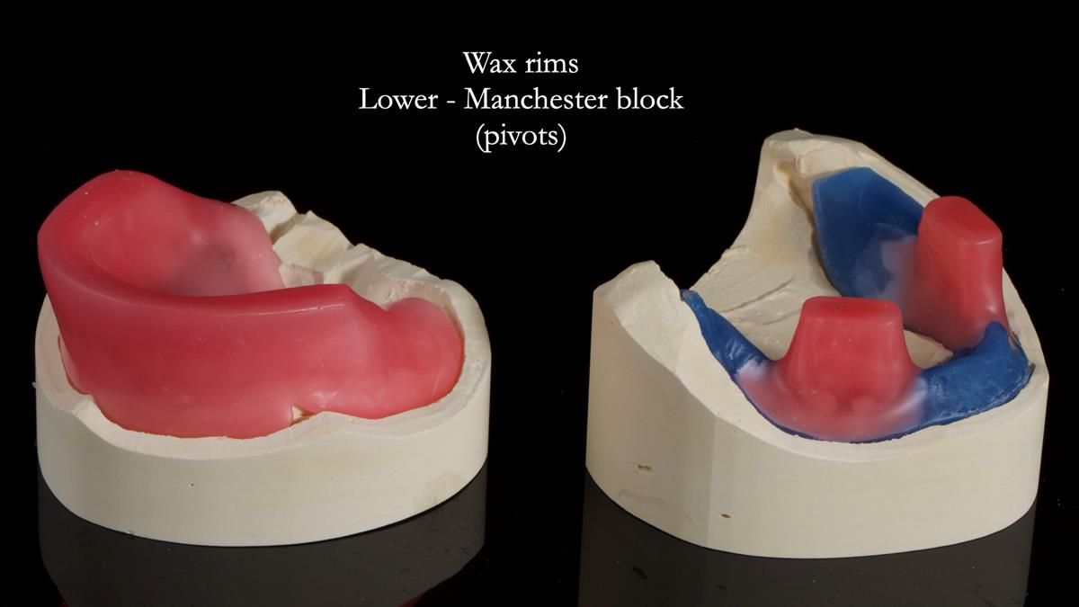 Fin’s Newsletter 88 — Complete dentures - full protocol… he rearranged his own teeth!