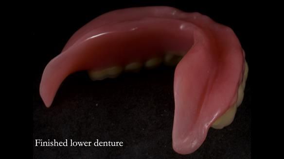 Newsletter 83: Sheila’s Complete Denture Success
