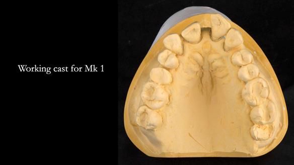 Finlay's Newsletter 63 Case study provision of metal based Scandinavian RPD - functional 10 years on