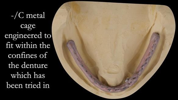Managing poor implant positioning with complete dentures and Locator attachments - full protocol Newsletter 41
