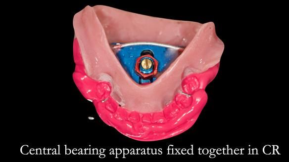 Solving Linda’s Failed “All on 4” implant bridges - full protocol Newsletter 42