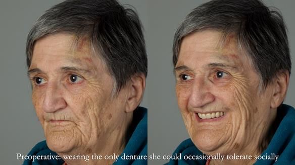 Newsletter 83: Sheila’s Complete Denture Success