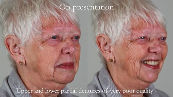 Finlay's Newsletter 59 Ultra hard partial dentures made for Gill