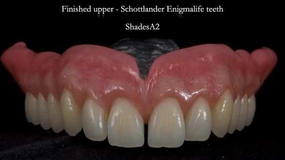 Newsletter 78: What do Clark Gable and a Locator® overdenture have in common?