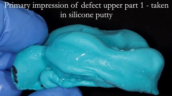 Upper metal base partial denture/occlusal stabilisation splint/obturator - full protocol