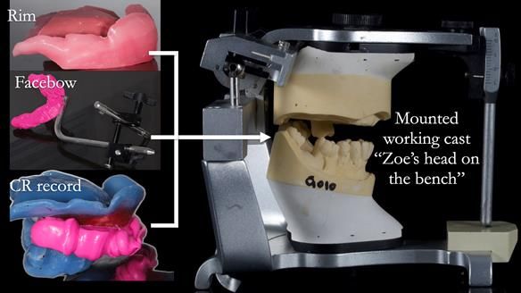 Finlay's Newsletter 58 Gasket upper partial denture for Zoe