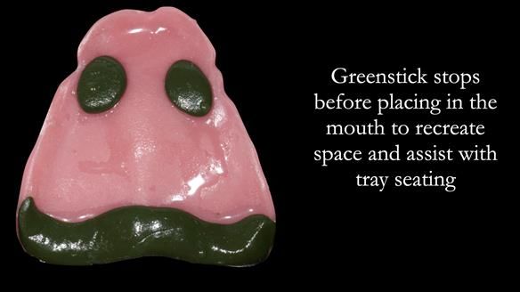 Replacing Madeline’s Complete denture FULL PROTOCOL