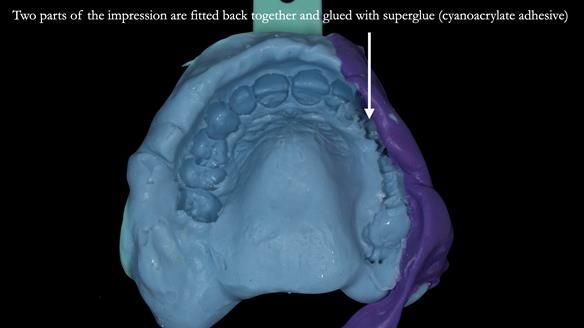 Newsletter 51 Managing Anne’s failing dentition with distal extension base RPD/Splint FULL PROTOCOL