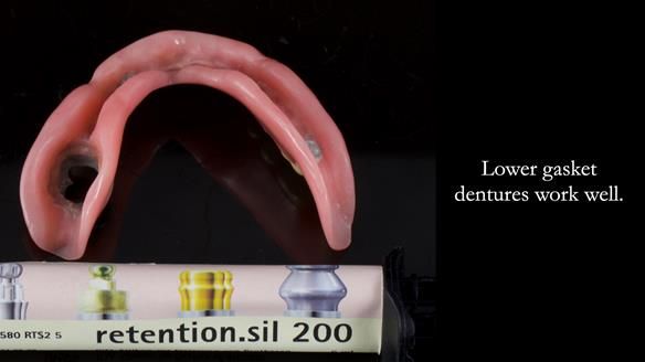 Finlay's Newsletter 58 Gasket upper partial denture for Zoe