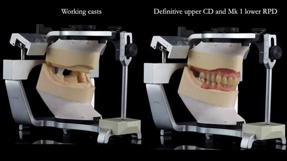 Newsletter 82 Mary - A complete upper and a one-tooth gasket denture