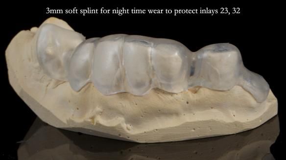 Newsletter 55 Provision of metal based partial dentures for Zephyrine with a repaired cleft lip and palate
