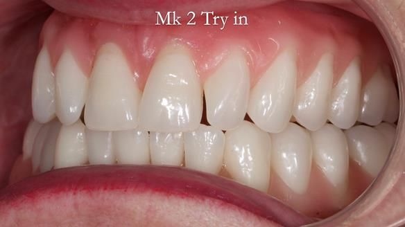 Replacing Madeline’s Complete denture FULL PROTOCOL