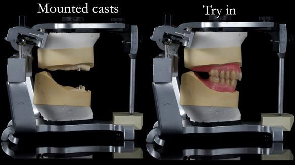 Newsletter 57 showcases the making and fitting process of implant-supported complete dentures for Alisdair