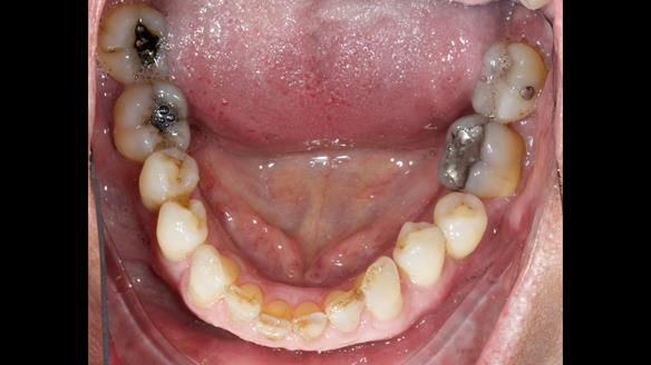 Finlay's Newsletter 64 case study - provision of a Kennedy class 2 metal based Scandinavian RPD for Ian