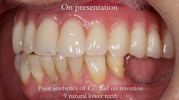 Solving Linda’s Failed “All on 4” implant bridges - full protocol Newsletter 42