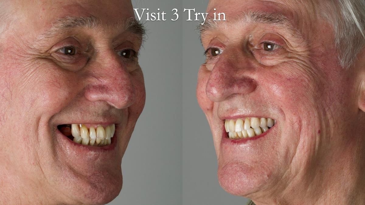 Newsletter 89 – Simon: A Challenging Kennedy Class II Division 1 Upper CoCr Partial Denture with a High Smile Line